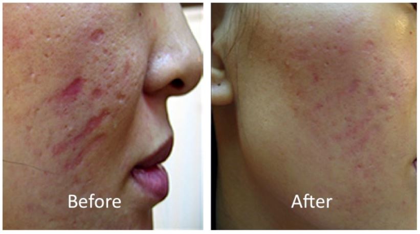 dermaroller before and after