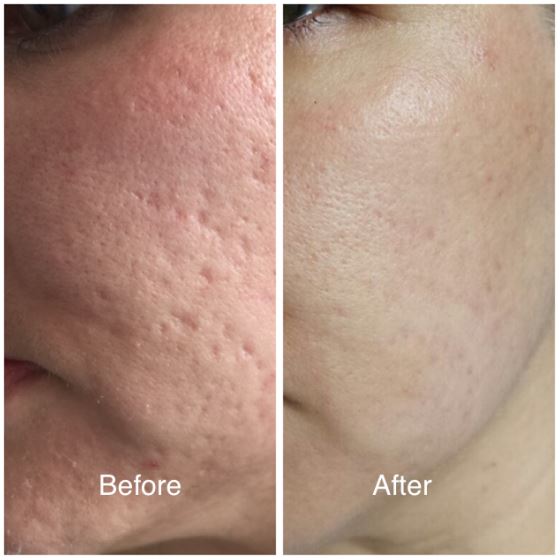 facial results